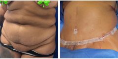 abdominoplasty-03