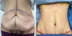 abdominoplasty-04