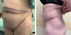 abdominoplasty-with-liposuction-01