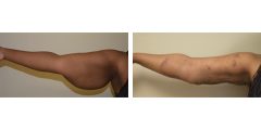 arm-lift-and-liposuction-01