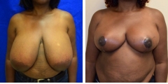 breast-reduction-001