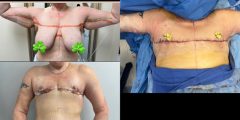 combined-top-surgery-and-arm-lift-01