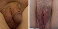 vaginoplasty-001