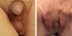 vaginoplasty-006
