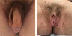 vaginoplasty-008