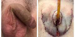 vaginoplasty-010