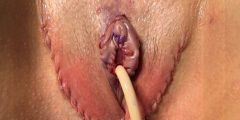 vaginoplasty-013