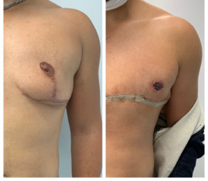 FTM Top Surgery Masculoplasty Plus Before & After Miami