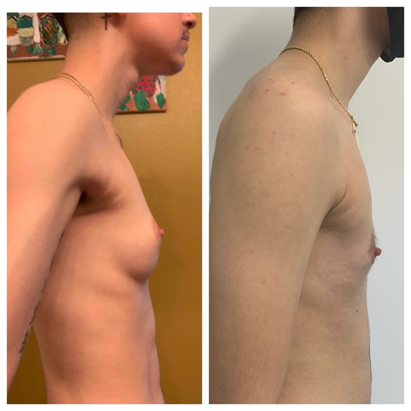 FTM Top Surgery- Masculoplasty Plus Recovery Miami 