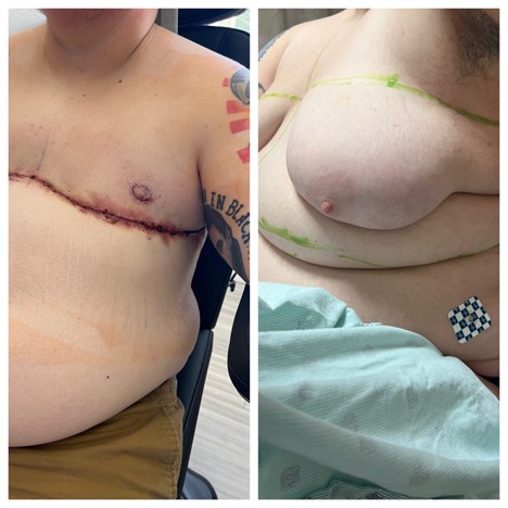 FTM Top Surgery Masculoplasty Plus Results Miami