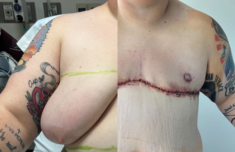 FTM Top Surgery Masculoplasty Plus Results Miami