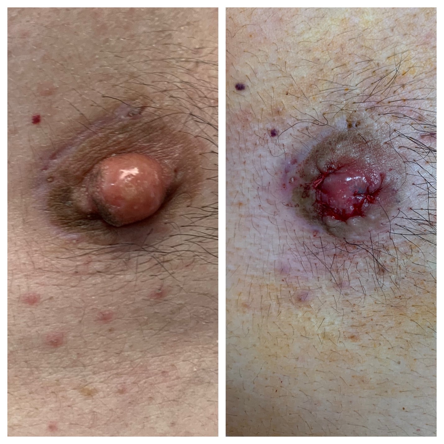 Male Nipple Correction Before and After Photos in Miami