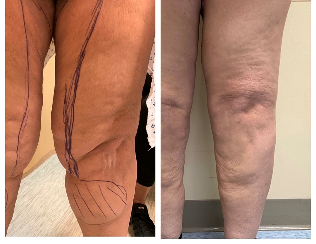 Thigh Lift (Thighplasty): Types, Surgery, Recovery & Scars
