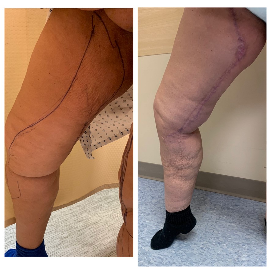 Thigh Lift Before and After Photos in Miami