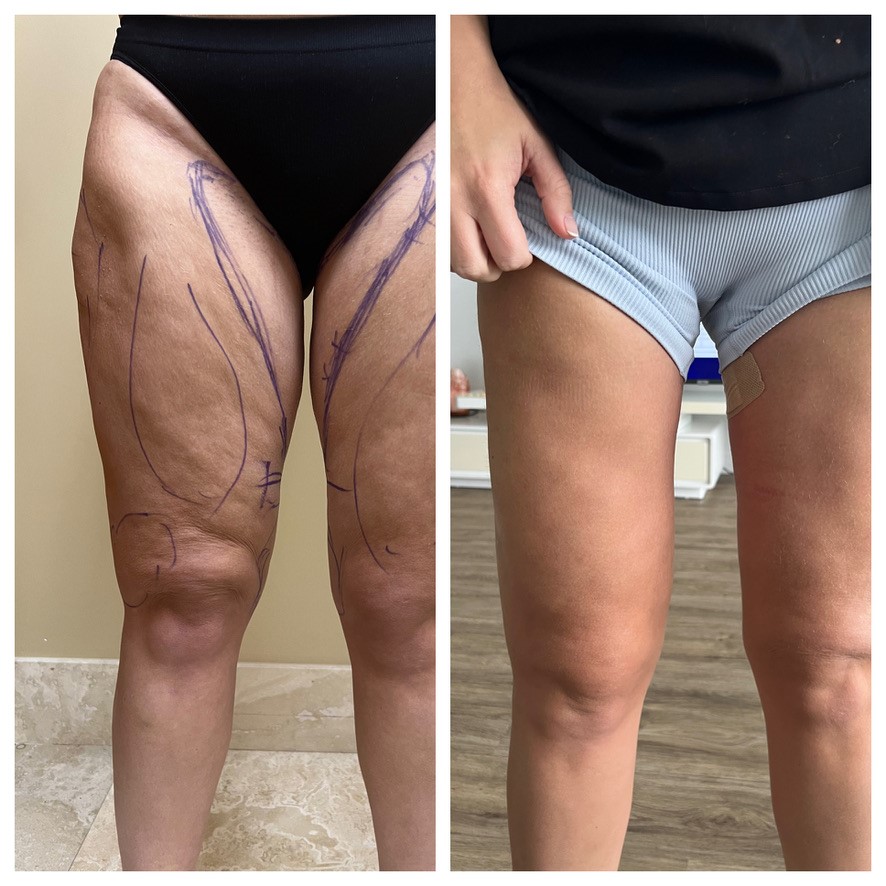 Thighplasty Before After Images from the front