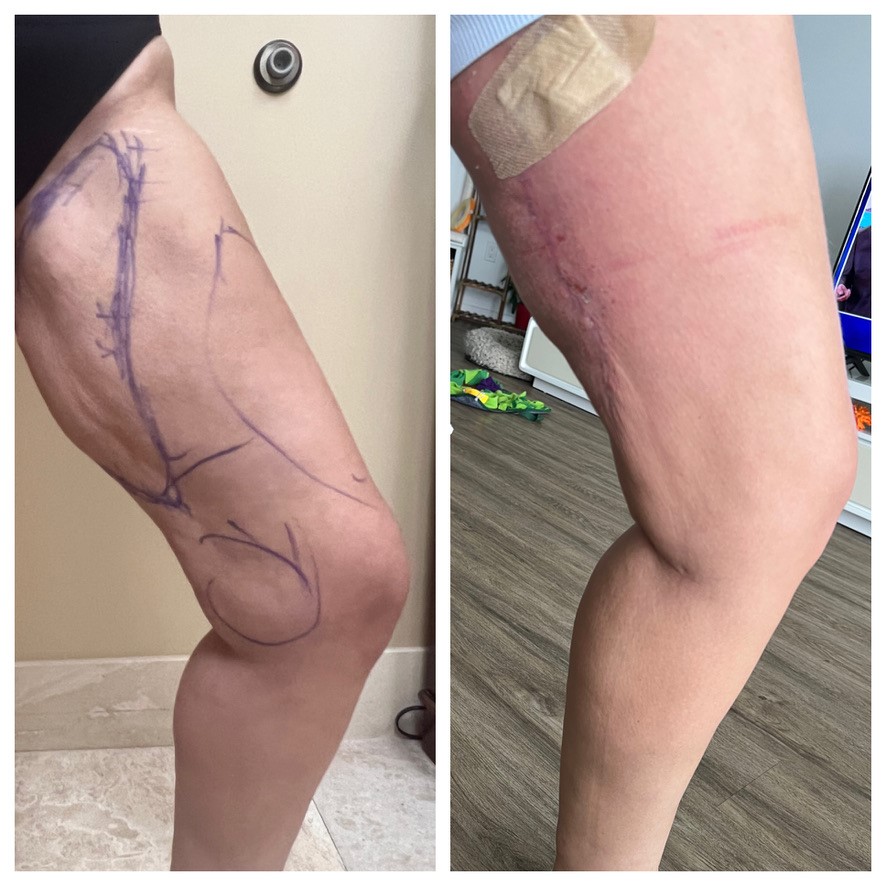 Thigh Lift Results (Inside Thigh View)