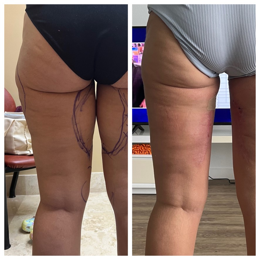 Thigh Lift Before and After Photos (Back Images)