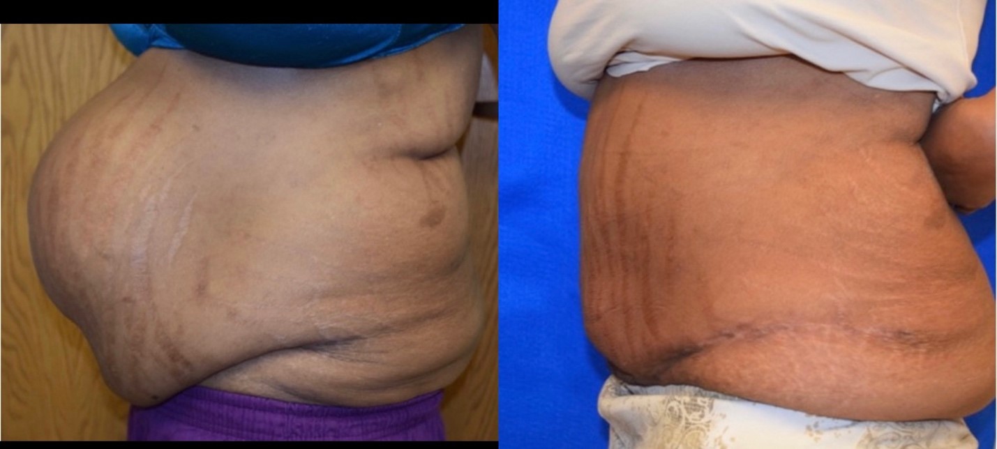 Drainless Abdominoplasty Before and After Photos in Miami