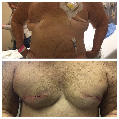 Postoperative view after bilateral prophylactic mastectomy and