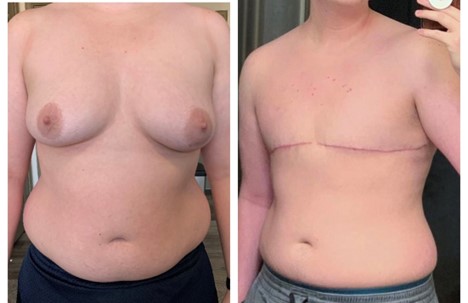 Aesthetic Flat Closure After Mastectomy Gains Recognition