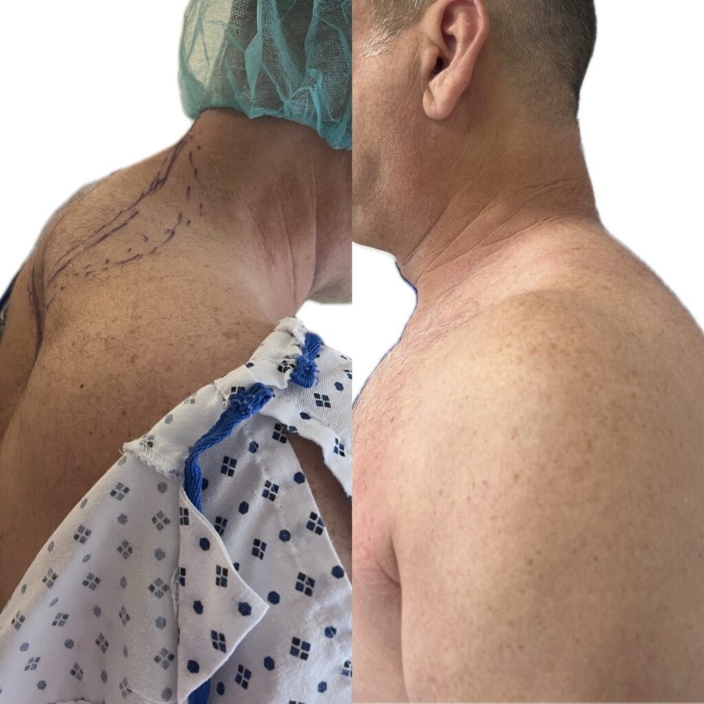 Buffalo hump Surgery Before & After In  Miami, FL