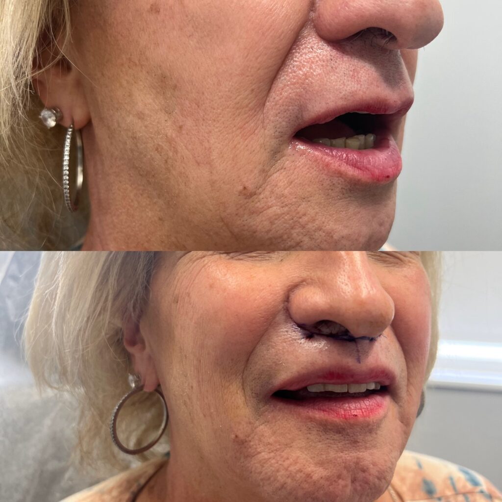 Miami Lip Lift Surgery Results before and after