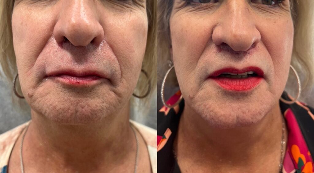 Lip life Surgery before & after In Miami, FL