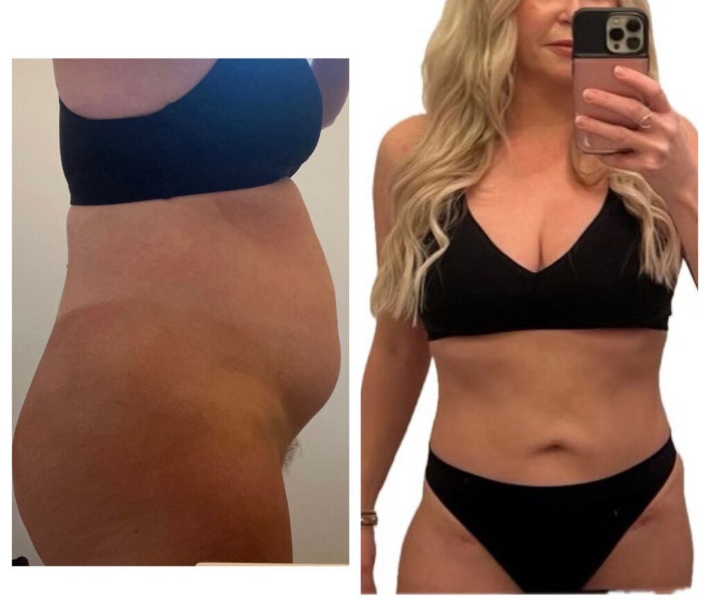 Liposuction 3 month Results befoer & after In Miami, FL