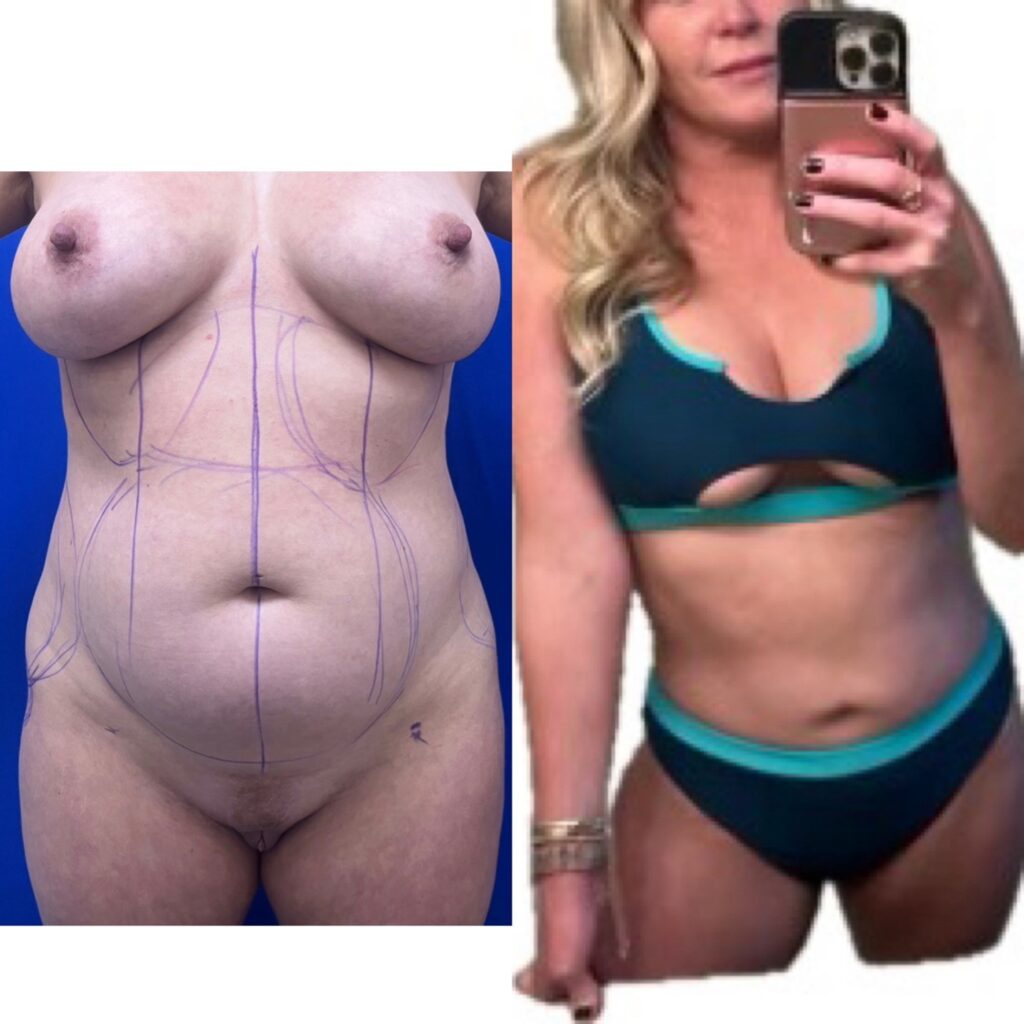 Miami Liposuction results before & after