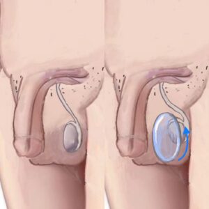 Buried penis Displacement Procedure Before & After in Miami, FL
