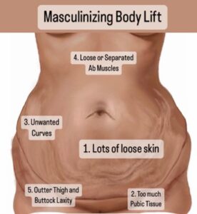 masculinizing body lift In Miami, FL