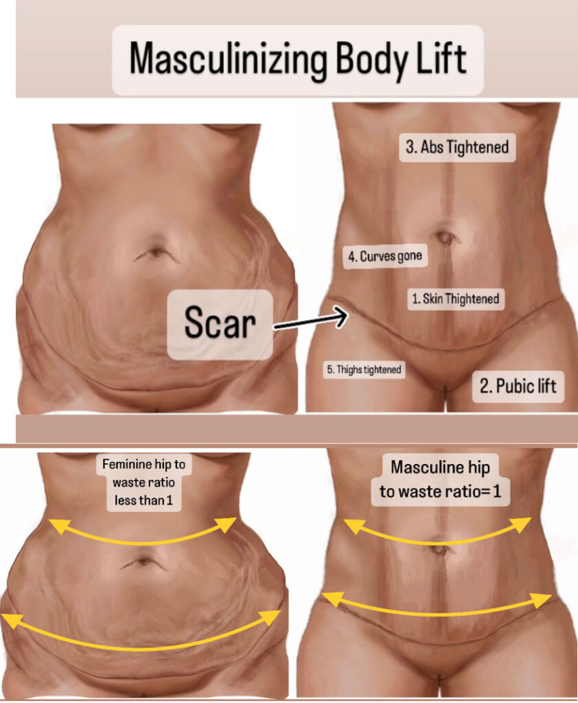 masculinizing body lift Torso Before & After In Miami, FL
