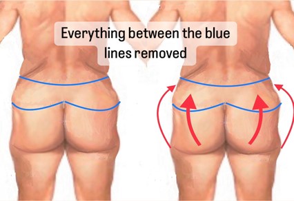 masculinizing Lower body lift before & after In Miami, FL