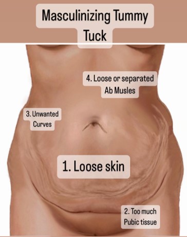 Eliminating Upper Abdominal Skin Rolls with Tummy Tuck