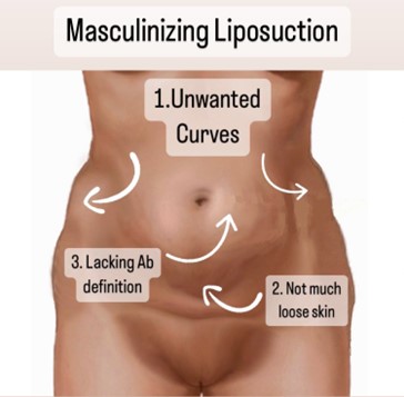 masculinizing Liposuction In Miami, FL