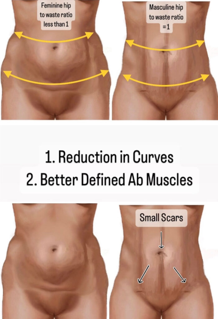 Before & after masculinizing Liposuction In Miami, FL