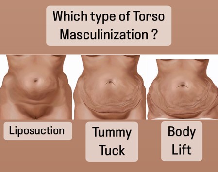masculinizing Torso body lift In Miami, FL