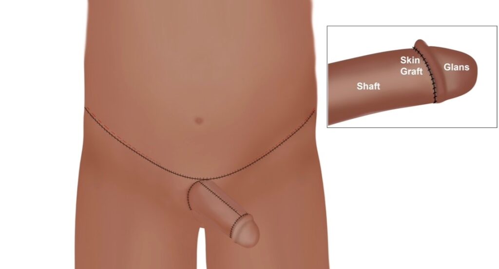 Typical scars for an abdophallo procedure