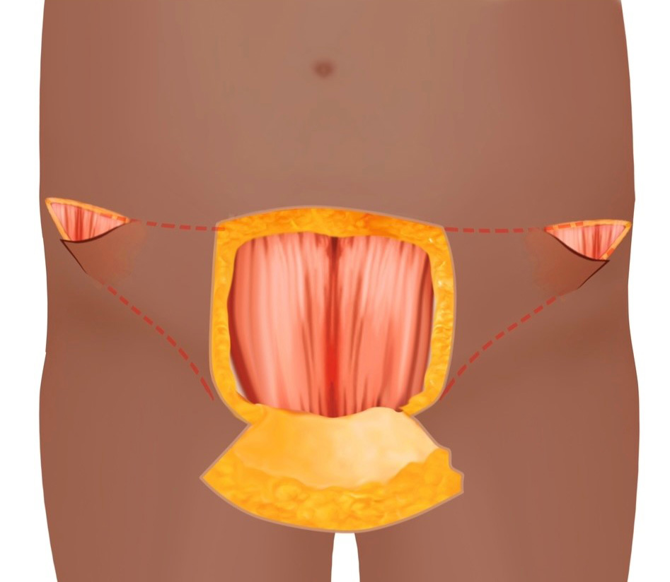 masculinizing tummy tuck for phalloplasty