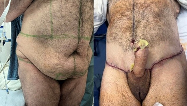 Phalloplasty Before after images in Miami