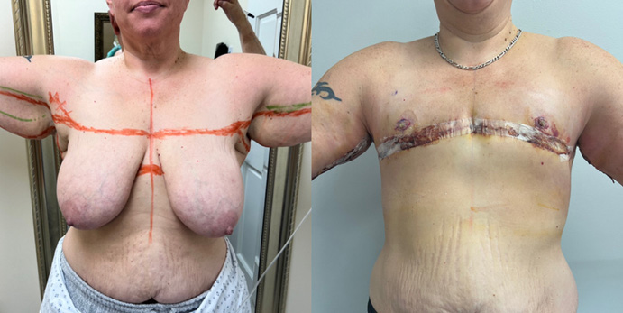 FTM Top Surgery Client Photos