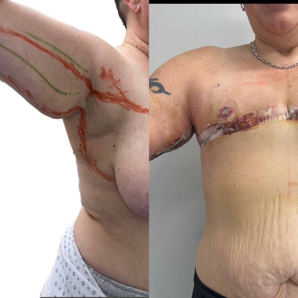 FTM Brachioplasty Photos in Miami