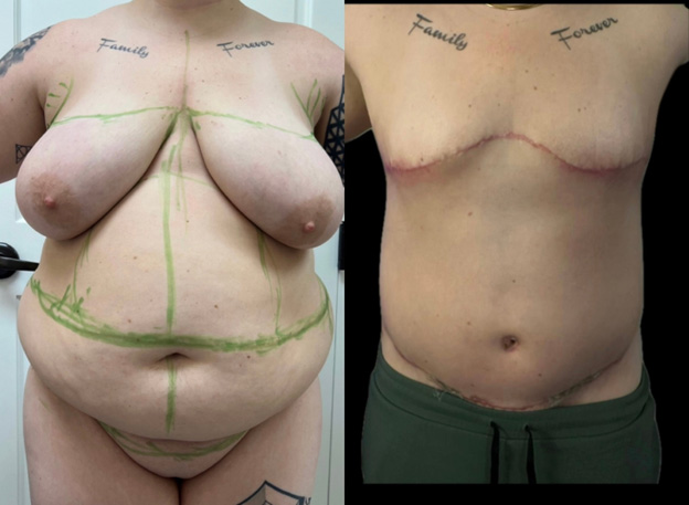 Five weeks after nonflat drain free nipple free top surgery with masculinizing abdominoplasty