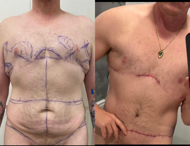 5 months after top surgery revision and masculinizing abdominoplasty