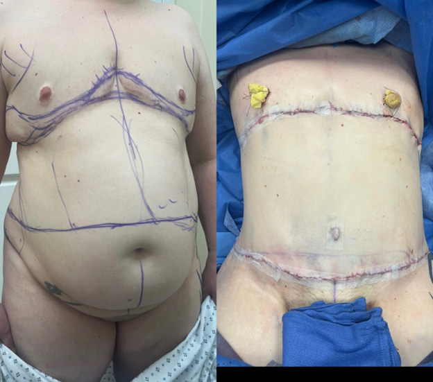 Immediate result following top surgery revision