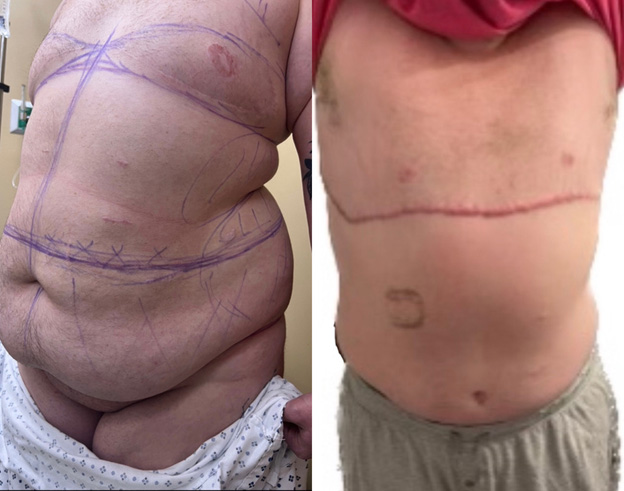 Five months after top surgery revision