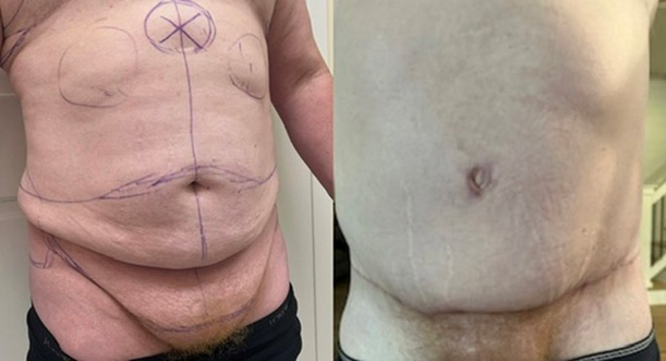 Five weeks after masculinizing tummy tuck with pubic lift