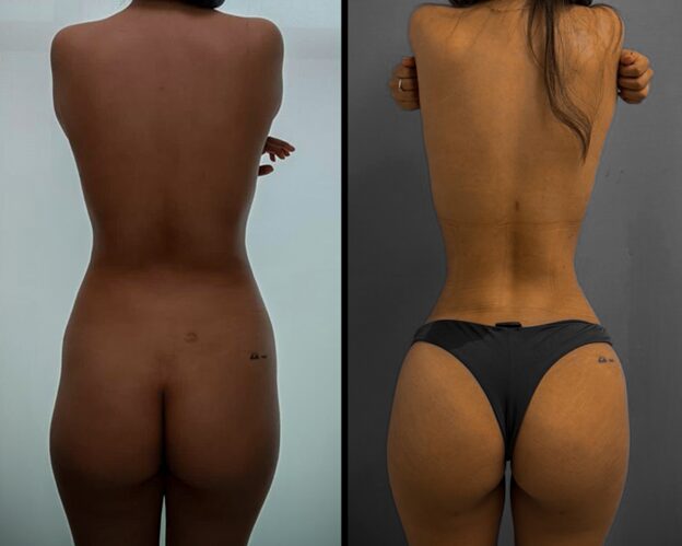 Rib Remodeling in Miami before and after