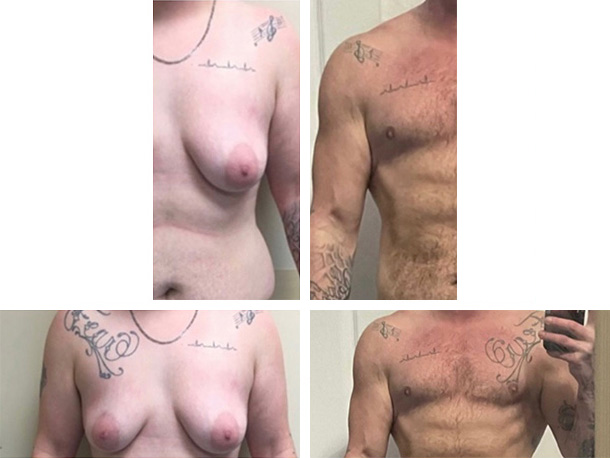 AFAB-Masculoplasty-02