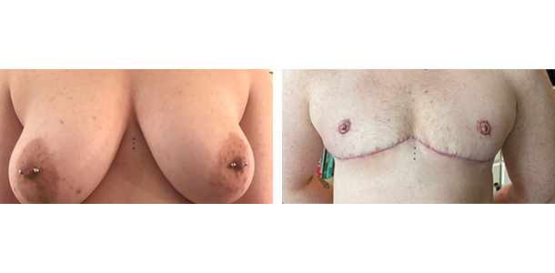 AFAB-Masculoplasty-03